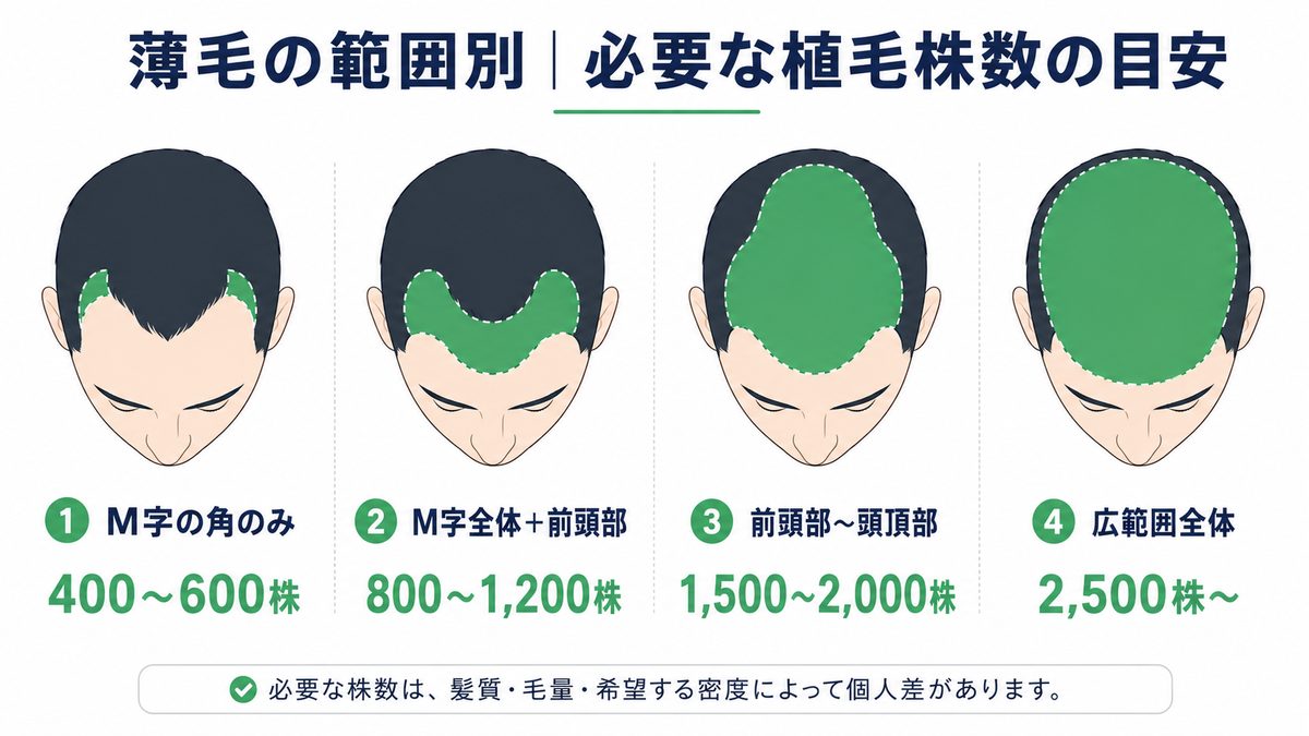 薄毛の範囲別に必要な自毛植毛の株数の目安（M字の角400〜600株／M字全体＋前頭部800〜1,200株／前頭部〜頭頂部1,500〜2,000株／広範囲2,500株〜）